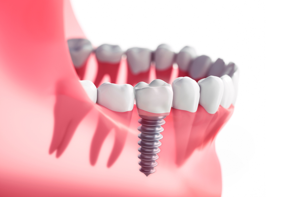 Implantologia dentale: a chi è indicata e quali vantaggi offre