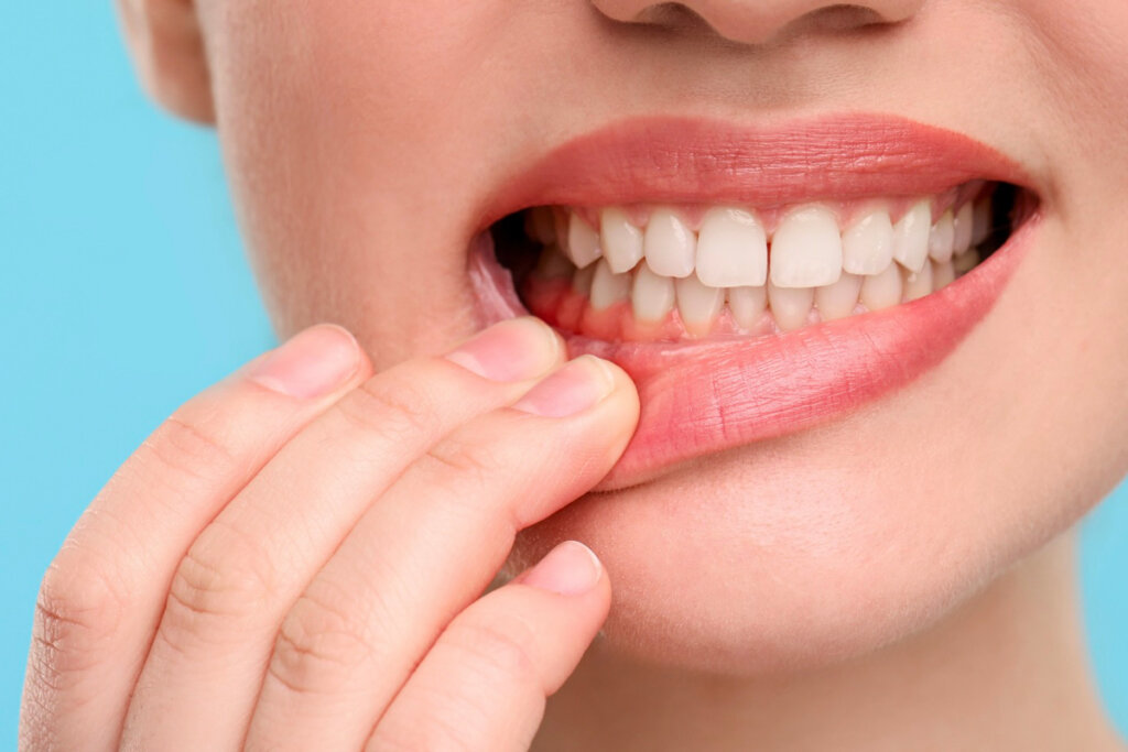 Perch&eacute; le gengive sanguinano? Cause e quando preoccuparsi