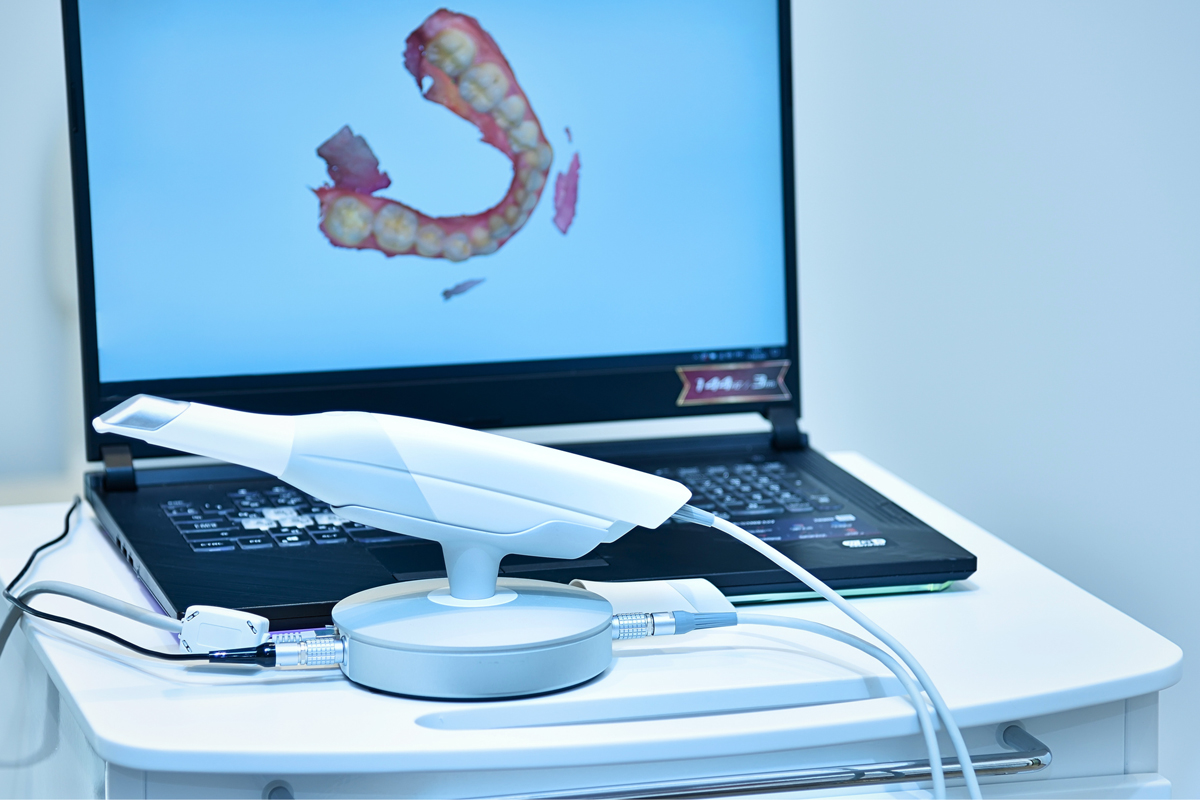 Scanner intraorale: addio alle impronte tradizionali